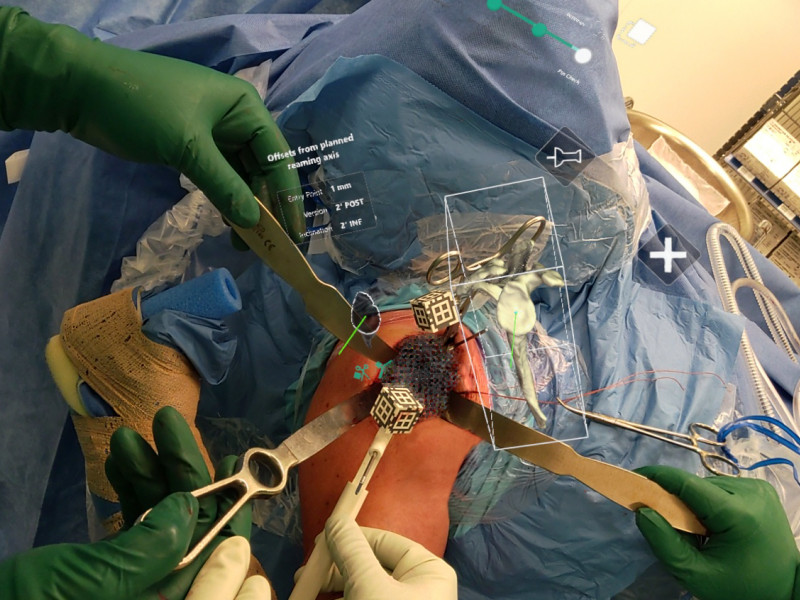 holo lens view during surgery