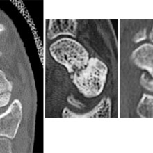 X-rays of scaphoid fracture